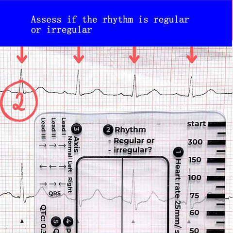 Triple Pack ECG 7 Step Ruler Set For ECG EKG Interpretation, Transparent Plastic Calipers Measuring Tool visible on ECG graph