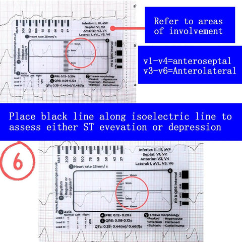 Triple Pack ECG 7 Step Ruler Set For ECG EKG Interpretation, Transparent Plastic Calipers Measuring Tool with diagrams